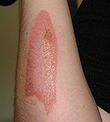 burnt arm